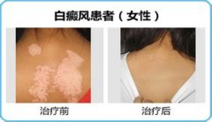 青少年白癜风不治会有什么后果