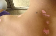 白癜风不治疗,随时给你带来这些压力