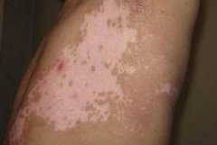 白癜风在秋季应该怎样护理呢