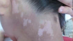 白癜风的危害有哪些