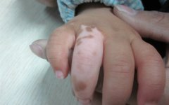 怎样能预防白癜风发病和扩散