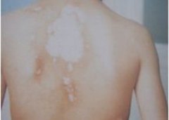 泛发型白癜风的治疗方法哪些管用