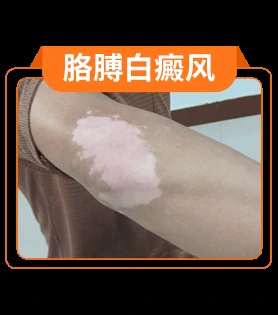 白癜风部位