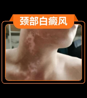 白癜风部位