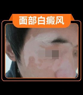 白癜风部位