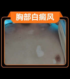 白癜风部位