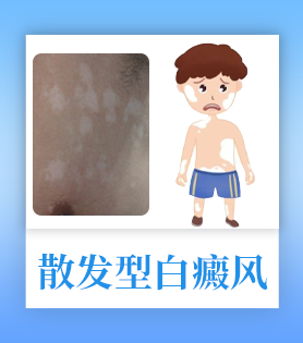 白癜风类型