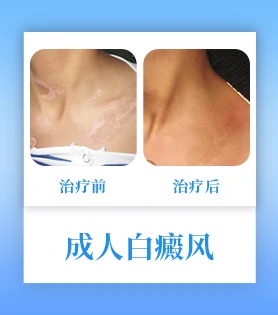 成人白癜风