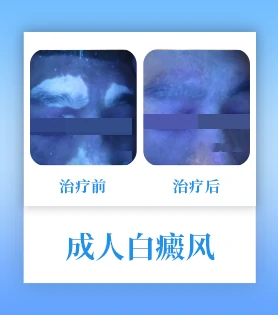 成人白癜风