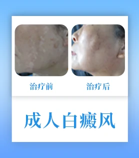 成人白癜风