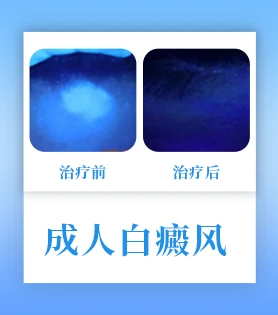 成人白癜风