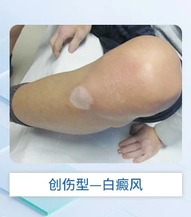 创伤型白癜风白斑病医院