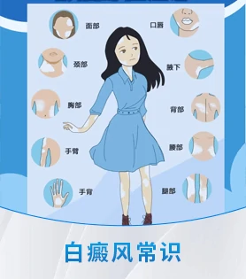 儿童白癜风