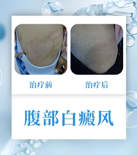 腹部白癜风