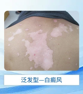 泛发型白癜风白斑病治疗