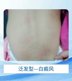 泛发型白癜风白斑病治疗
