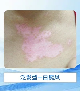 泛发型白癜风白斑病治疗