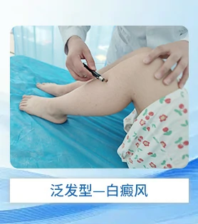 泛发型白癜风白斑病治疗