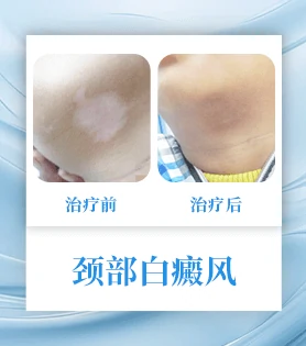 颈部白癜风