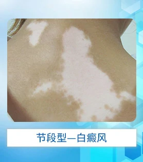 节段型白癜风白斑病