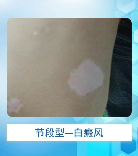 节段型白癜风白斑病