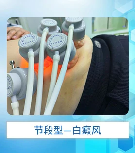 节段型白癜风白斑病