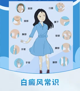 局限型白癜风