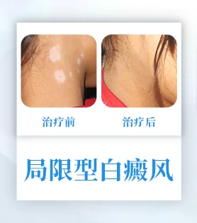 局限型白癜风