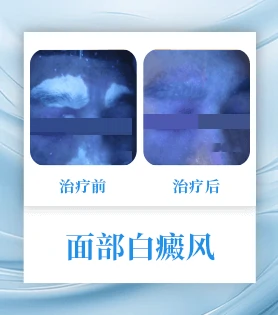 面部白癜风