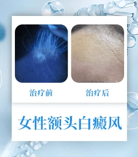 女性白癜风