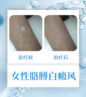 女性白癜风