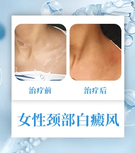 女性白癜风