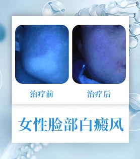女性白癜风