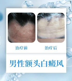 男性白癜风