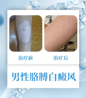 男性白癜风
