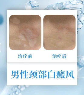 男性白癜风