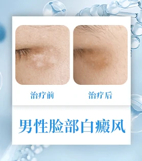 男性白癜风