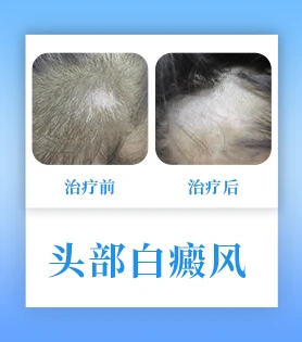 头部白癜风