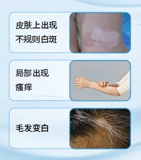 腿部白癜风