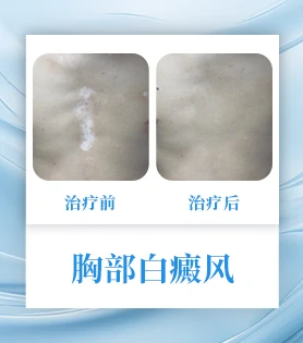 胸部白癜风