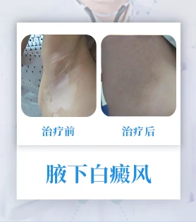 腋下白癜风
