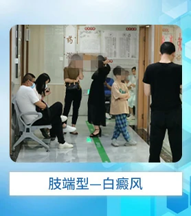 肢端型白癜风白斑病
