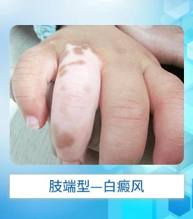 肢端型白癜风白斑病