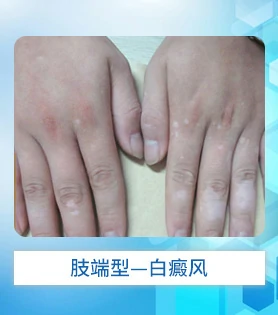 肢端型白癜风白斑病