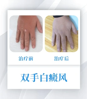 指趾白癜风